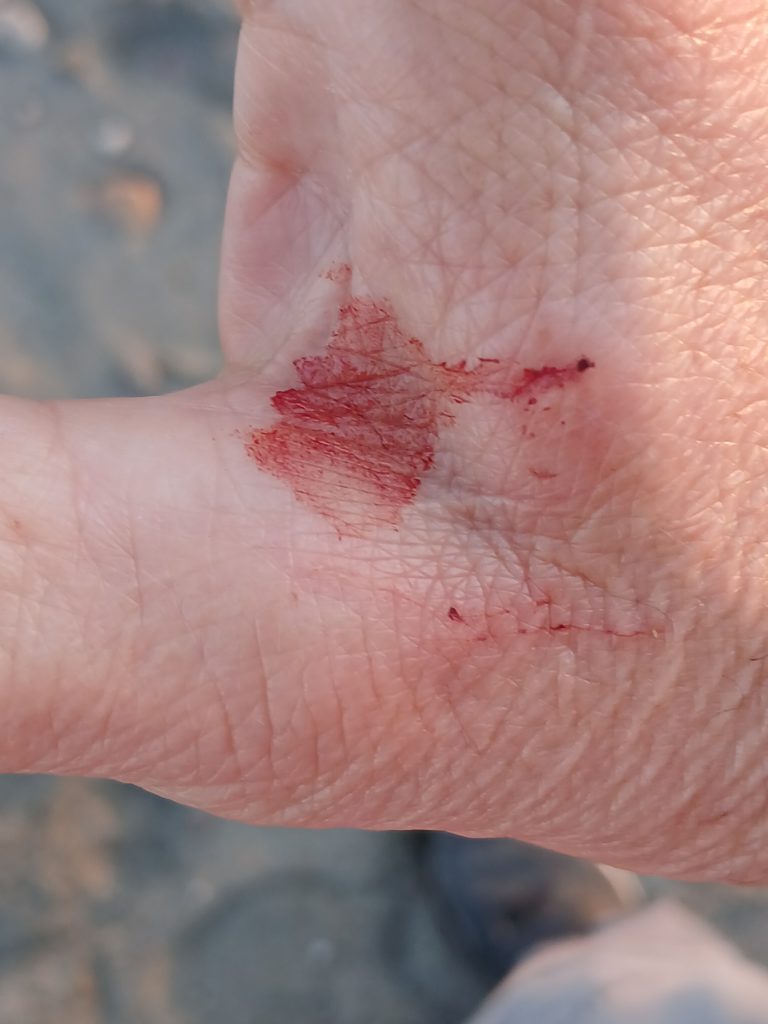 Bird damage to my hand. It knew right where to go to inflict maximum pain.